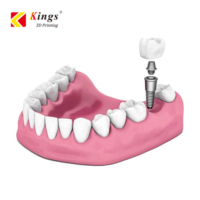How SLM 3D printers are applied in dental industry？